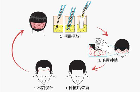 发际线种植是的吗？对于发际线种植你了解多少