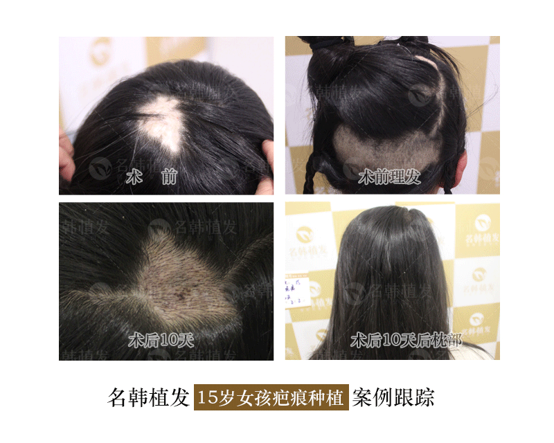 疤痕上种植头发可以淡化疤痕吗？