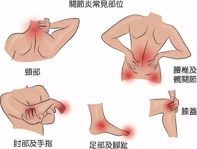 骨关节炎诊疗的三大误区