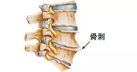 骨刺”是一种病吗？一起来看看吧