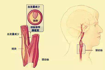 身体出现颈动脉斑块，你注意到了吗？