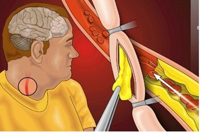 颈动脉斑块是怎么形成的？