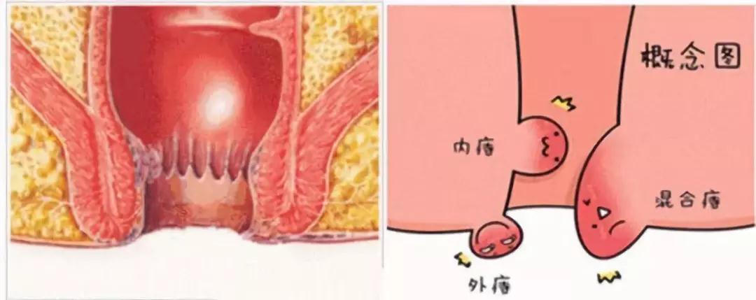  痔疮有3型4期，快来对照下，你是哪一型，哪一期？