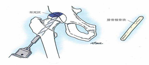 侯洪涛解答股骨头坏死都有什么好的治疗方法