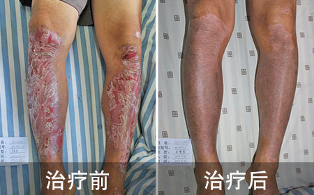 小伙苦治腿部银屑病11载 终于在潍坊恢复健康
