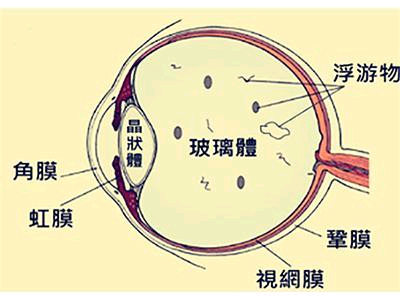 玻璃体混浊主要分几类，表现有哪些？