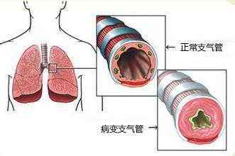 慢性支气管炎发作怎么办？日常护理很重要！