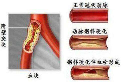 发现颈动脉斑块一定要当心