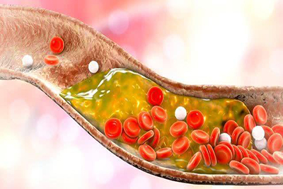 高血脂增加心脑血管危险，2个原则控血脂