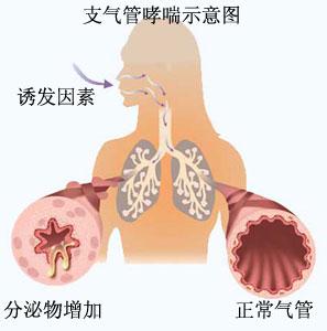 难缠的支气管哮喘，我们应该拿它怎么办？