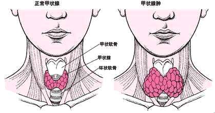 脾气又臭又硬的甲亢，到底给人们带来什么样的影响