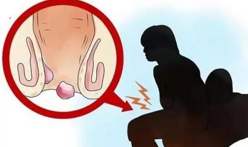 痔疮总不见好？是因为你日常习惯没做对！