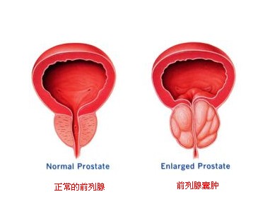 有效预防前列腺囊肿的措施是什么？要知道这些