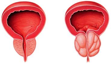 预防前列腺囊肿的方法有哪几种？希望你知道