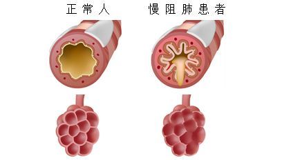 慢阻肺是否会传染？患者患病会有哪些症状？