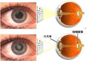 白内障那点事你知道吗潍坊明润眼科医院