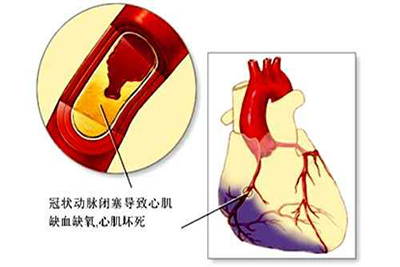 冠心病吃点什么保健品好？做好这些控制和预防更重要