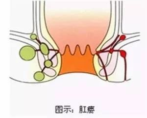  痔、裂、肛瘘、大便失控都与肛管直肠压力有着不一般的“关系”？