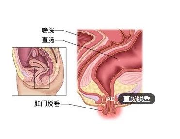  痔、裂、肛瘘、大便失控都与肛管直肠压力有着不一般的“关系”？