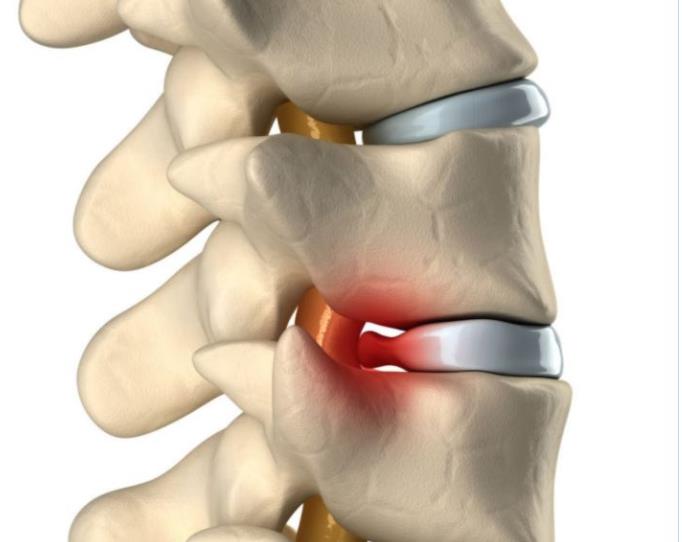 腰间盘突出到底能治愈吗?应该怎么康复?医生不会告诉你的
