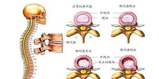 年纪轻轻就腰疼（腰突）？我劝你早防范！