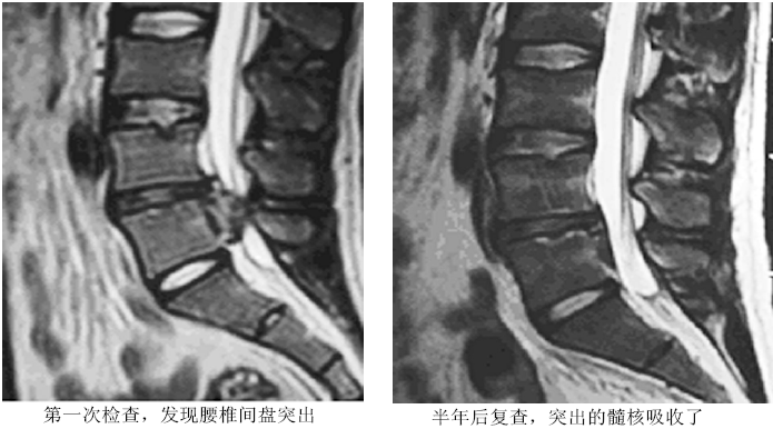 突出的椎间盘真能回去？只不过不是推回去的……