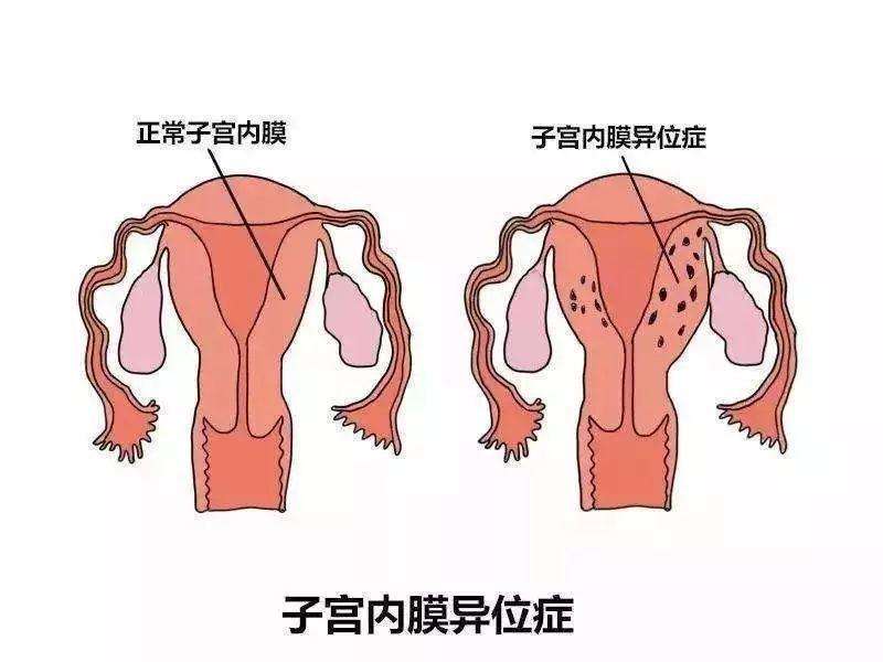 成都生殖研究中心医生谈：子宫肌瘤、子宫腺肌症、子宫内膜异位症的区别