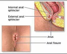 肛裂复发？看看你是不是又便秘了