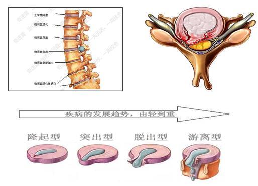 怎么预防腰间盘突出？预防腰间盘突出的措施有什么？