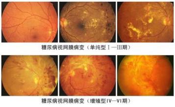 视力再好,糖友也要定期检查眼底