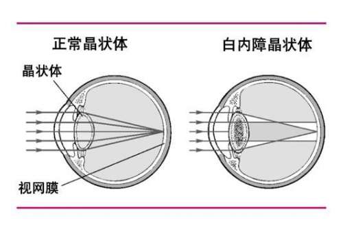 白内障的整体手术流程你对白内障的手术流程知道多少