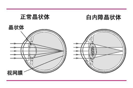 白内障的整体手术流程？你对白内障的手术流程知道多少