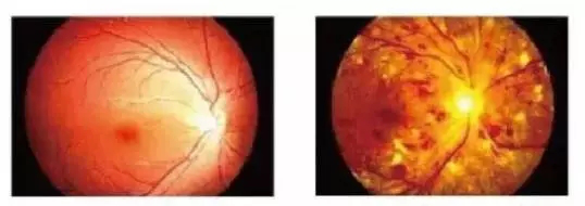 视力明明还好，为什么还要需要检查眼底？