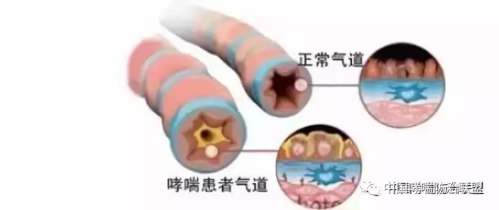 什么是气道高反应性？有气道高反应性就一定会患哮喘吗？