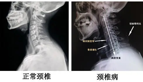 如何摆脱困扰你长时间的颈椎病？受益匪浅，快告诉大家吧！