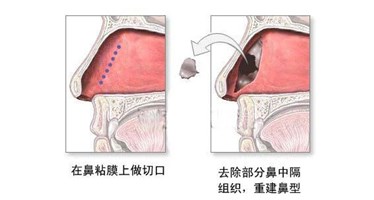 北京哪所医院耳鼻喉科好-鼻中隔偏曲不可不知的危害表现