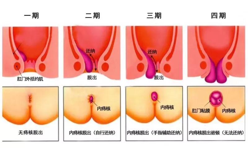 咳嗽一下或打个喷嚏直肠就从肛部脱出，是第几期？