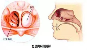 北京哪家医院做鼻息肉好-鼻息肉的主要症状是什么