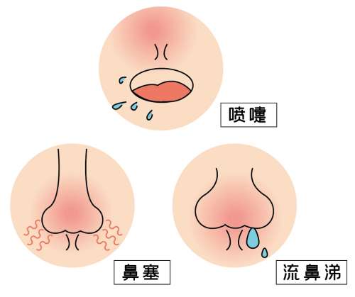 鼻炎七大类，你属于哪一类