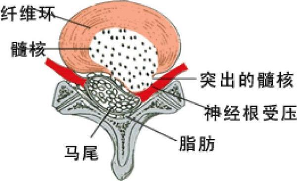 老年人在冬季应该如何预防腰椎病方法