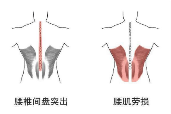 老年人在冬季应该如何预防腰椎病方法