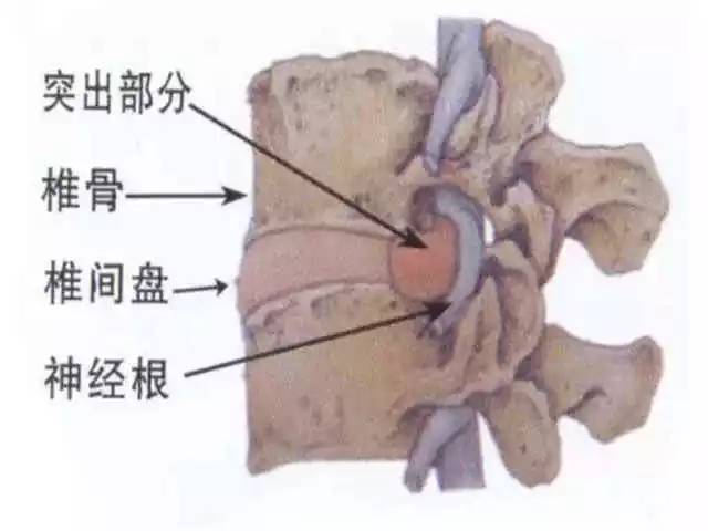 要想预防腰椎病要从生活习惯做起