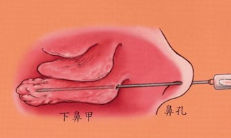 北京哪家医院治疗外耳道炎好-鼻甲肥大的危害都有哪些呢