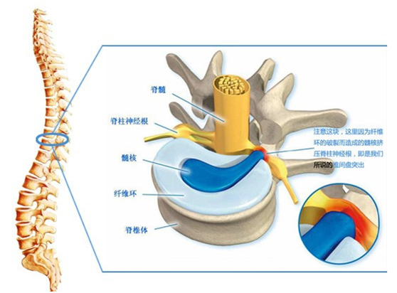 腰间盘突出的饮食调理