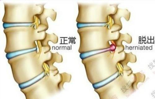 腰间盘突出的禁忌