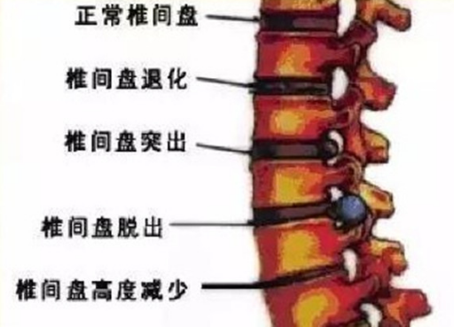 经上下终板软骨的裂隙进入椎体松质骨内,一般仅有腰痛,无神经根症状