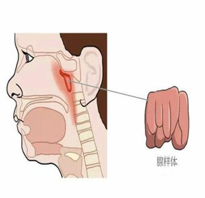 北京治腺样体肥大的医院，腺样体肥大的预防需要注意哪些