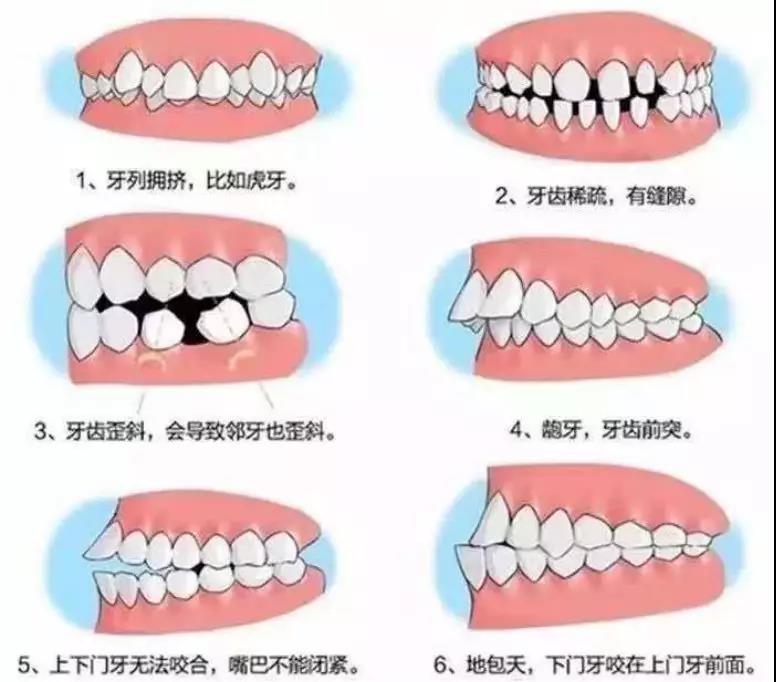 12岁才可以开始矫正的观念，到底耽误了多少孩子？