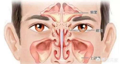 鼻窦炎如何治疗？需要注意什么？