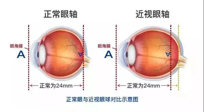 还在用“甜食”奖励孩子吗？小心它让孩子成为近视眼